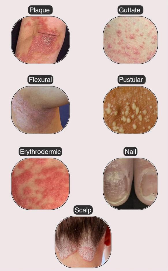 Unraveling the Connection Between Psoriasis and the Immune System