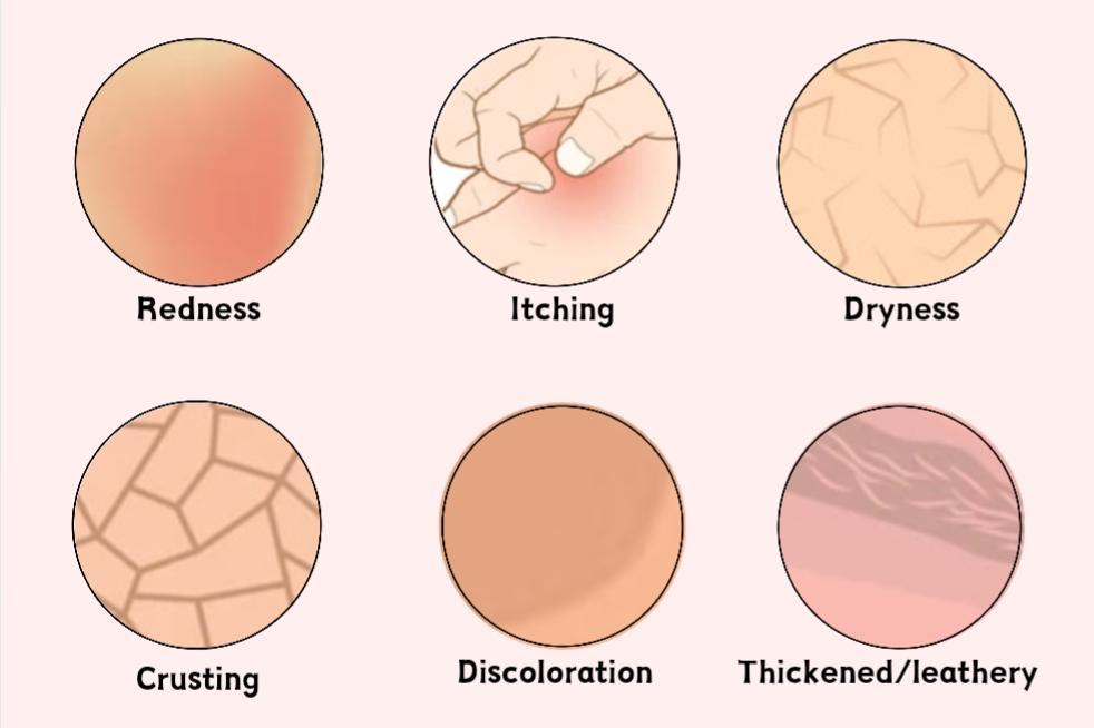 How to know we have Eczema skin problem?