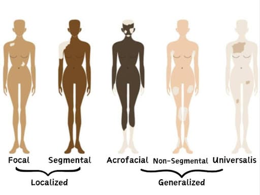 Types of Vitiligo
