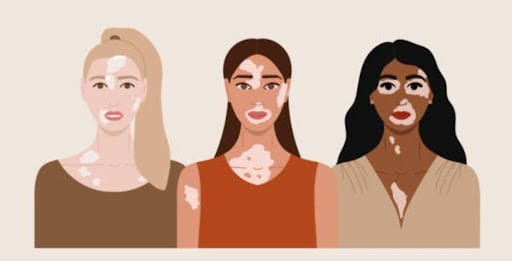 Vitiligo Treatment